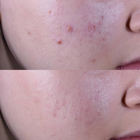 PERRICONE MD   Blemish Relief Ultra-Boost Clearing Treatment 59ml-  lekki krem oczyszczający z kwasem salicylowym